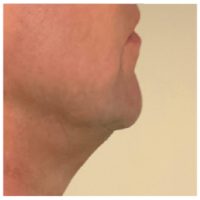 Before and after fat dissolving-to chin