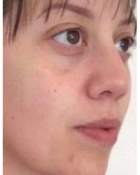 Dermal fillers to mid and lower face