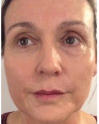 Cheek and lower face volumising fillers