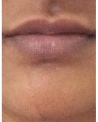 Dermal filler to scar and top lip