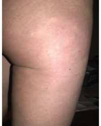 Skin needling and Mesotherapy to improve cellulite